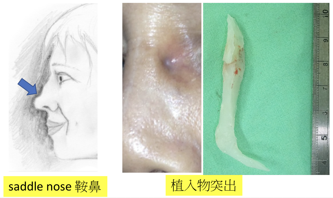 隆鼻的美麗與風險 – 整形外科 黃書鴻
